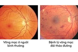 Bệnh võng mạc đái tháo đường - chủ quan có thể dẫn đến biến chứng mù lòa