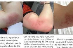 Không chủ quan với biến chứng zona chỉ sau 48 giờ