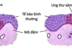 Phát hiện loạn sản độ cao:- cơ hội chặn đứng ung thư từ sớm