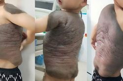 6 cuộc đại phẫu cứu b&eacute; trai mang 'mai r&ugrave;a' tr&ecirc;n lưng suốt 7 năm