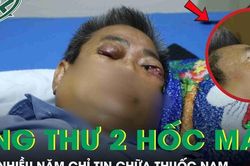 Người đàn ông 61 tuổi ung thư 2 hốc mắt sau nhiều năm chỉ tin chữa thuốc nam