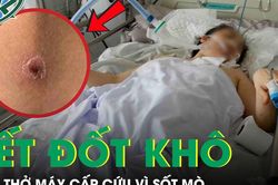 Người phụ nữ 49 tuổi lâm bạo bệnh, phải thở máy cấp cứu chỉ từ một vết đốt khô