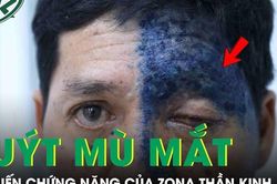 Người đàn ông 54 tuổi suýt mù mắt do biến chứng nặng của zona thần kinh