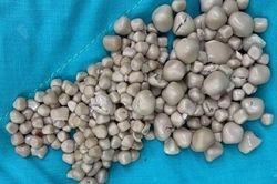 Những dấu hiệu cảnh báo sỏi thận giai đoạn đầu