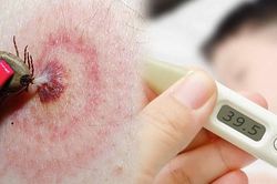 Suy đa tạng do mò đốt, đặc trưng của bệnh sốt mò cần biết