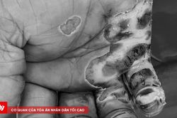 Bỏng nặng vì thả diều gần đường điện cao thế