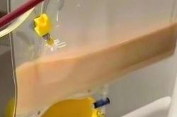Người phụ nữ 39 tuổi 'máu trắng đục như sữa' vì uống thứ nước quen thuộc nhiều người mê