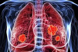 Người đàn ông 59 tuổi phát hiện ung thư phổi thừa nhận 1 sai lầm suốt 30 năm nhiều nam giới Việt mắc phải