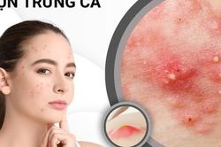 Mụn trứng cá kéo dài tới tuổi nào mới hết?