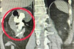 Người đ&agrave;n &ocirc;ng 51 tuổi 'thận sỏi như san h&ocirc;' v&igrave; uống thứ nước quen thuộc nhiều người m&ecirc;