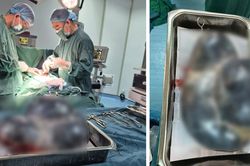 Quảng Trị: Cắt bỏ th&agrave;nh c&ocirc;ng khối u buồng trứng nặng khoảng 5kg