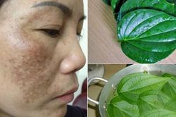 Mách bạn 4 cách trị nám lâu năm từ thiên nhiên, rẻ tiền nhưng cực nhạy