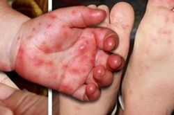 Tay chân miệng tăng nhanh ở Khánh Hòa, bác sĩ khuyến cáo người dân không chủ quan