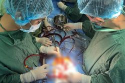 Bệnh viện HNĐK Nghệ An thực hiện thành công ca thay van và gốc động mạch chủ phức tạp