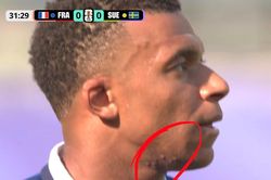 Nốt sần sùi trên mặt Mbappe thu hút gần 60 triệu view