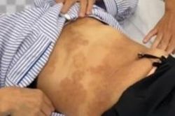 Nhập viện v&igrave; nhiễm c&ugrave;ng l&uacute;c 5 loại k&yacute; sinh tr&ugrave;ng