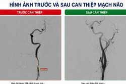 Nhồi m&aacute;u n&atilde;o cấp sau khi chơi b&oacute;ng đ&aacute; do tổn thương động mạch cảnh