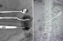 Tìm thấy nhiều bàn chải đánh răng, thìa inox trong dạ dày nam thanh niên Hà Nội