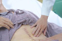 Cứu người đàn ông nguy kịch vì phình động mạch chủ bụng