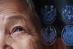 Hy vọng mới trong điều trị Parkinson với liệu pháp tế bào gốc chỉnh sửa gene