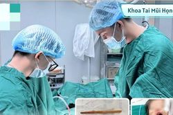Ngậm đũa khi chơi, bé 2 tuổi suýt thủng sọ não