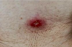 Cụ bà 88 tuổi nhiễm trùng toàn thân vì sốt mò từ vết đốt nhỏ