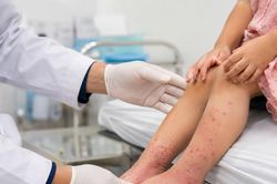 Bé gái 5 tháng tuổi nhập viện vì bong vảy toàn thân, bác sĩ phát hiện bệnh hiếm