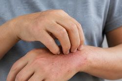 Ngứa ở 2 vị tr&iacute; tr&ecirc;n cơ thể c&oacute; nguy cơ l&agrave; biểu hiện xơ gan