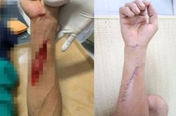 Bị kính vỡ cắt phải, người đàn ông suýt mất chức năng bàn tay do đứt gân, tổn thương nặng