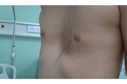 4 dấu hiệu phát hiện lõm ngực bẩm sinh ở trẻ