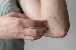 Gặp triệu chứng này, suy nghĩ đến xổ giun ngay