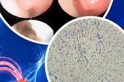 Phẫu thuật thành công dị tật đường thở hiếm gặp cho bé gái 1 tháng tuổi