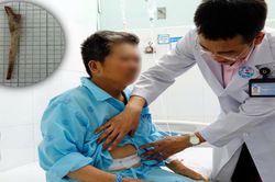 Người đàn ông suýt mất mạng vì mảnh xương đâm thủng dạ dày