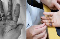 Ngày đầu đi làm, thanh niên 17 tuổi suýt mất 3 ngón tay vì máy cưa