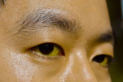 Dấu hiệu ở người mắc viêm gan giai đoạn đầu