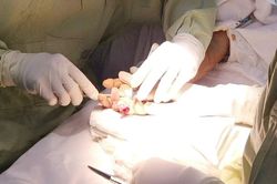 10 giờ vi phẫu giữ lại 3 ngón tay dập nát cho thanh niên 17 tuổi