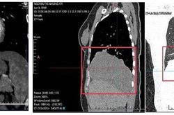 Đi khám vì đau tức ngực và ho khan, cô gái phát hiện khối u gần 15cm