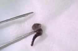 Người đàn ông 24 tuổi chảy máu mũi sau khi uống nước suối, bác sĩ phát hiện 'bí mật đáng sợ'