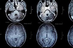 Thử nghiệm vaccine điều trị u não, mở ra hy vọng kéo dài sự sống cho bệnh nhân