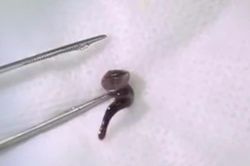 Uống nước ở suối, nam thanh niên bị con đỉa dài 2,5cm chui vào mũi
