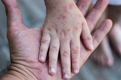 Trẻ bị tay chân miệng, khi nào cần đưa đi viện ngay?