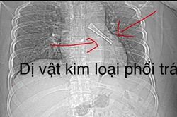 Gắp th&agrave;nh c&ocirc;ng c&aacute;n th&igrave;a mắc s&acirc;u trong phế quản người đ&agrave;n &ocirc;ng