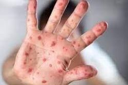 Anh ghi nhận ca tử vong đầu tiên ở người lớn do mắc sởi