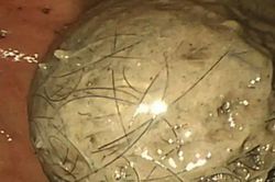 B&eacute; g&aacute;i 10 tuổi đau bụng suốt 3 năm, bố mẹ sốc khi b&aacute;c sĩ lấy ra thứ 'đ&aacute;ng sợ' trong bụng