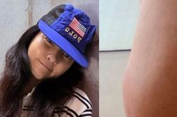Nữ diễn viên nổi tiếng phải nhập viện sau khi bị rết cắn