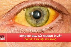 5 dấu hiệu ở mắt có thể cảnh báo não bộ đang gặp vấn đề