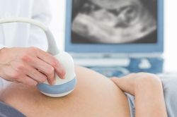 Tắc mạch ối ở sản phụ hiếm gặp nhưng nguy hiểm