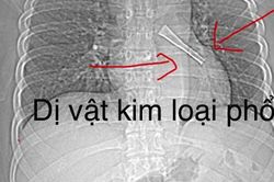 Ho không dứt, bác sĩ phát hiện cán thìa inox mắc trong phế quản bệnh nhân