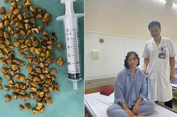 Bác sĩ lấy ra hàng trăm viên sỏi trong túi mật của nữ bệnh nhân 39 tuổi