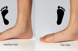 Bàn chân bẹt: Hội chứng dễ bị bỏ sót ở trẻ nhỏ